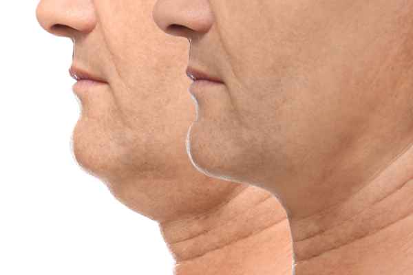 HIFU - Breakthrough in Anti - ageing 2 hifu results Maidstone