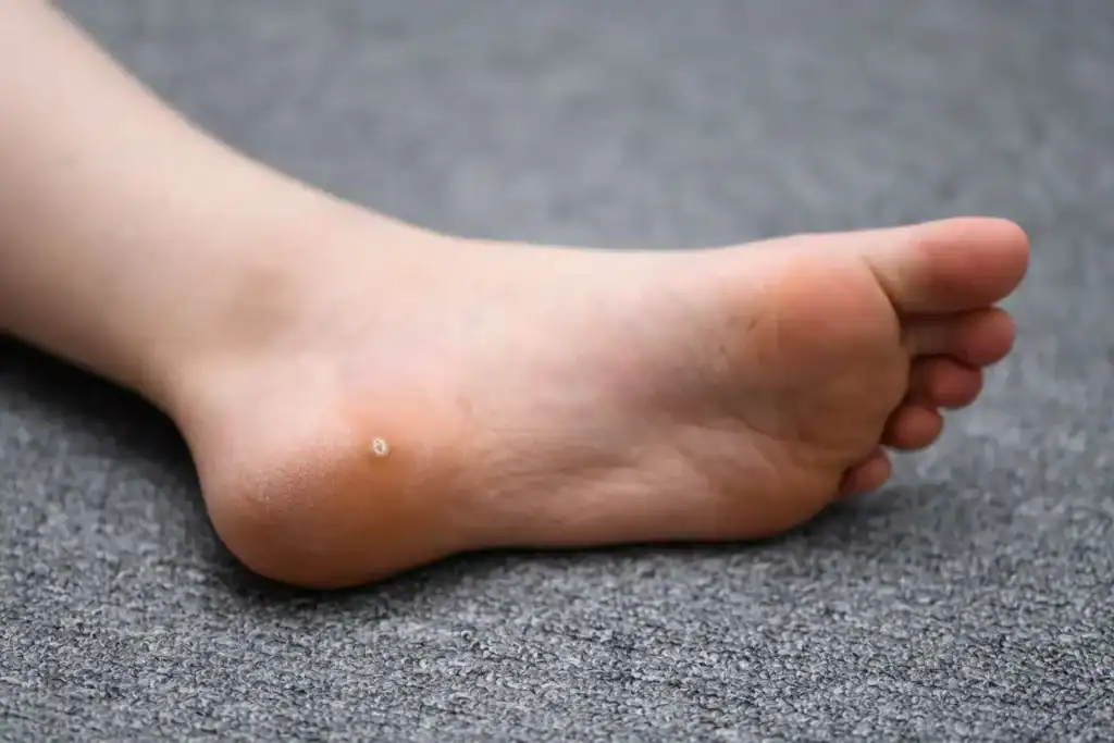 Cryotherapy For Warts And Also Verrucas 2 Image of verruca on the bottom of the foot that able to be treated with Cryotherapy Maidstone
