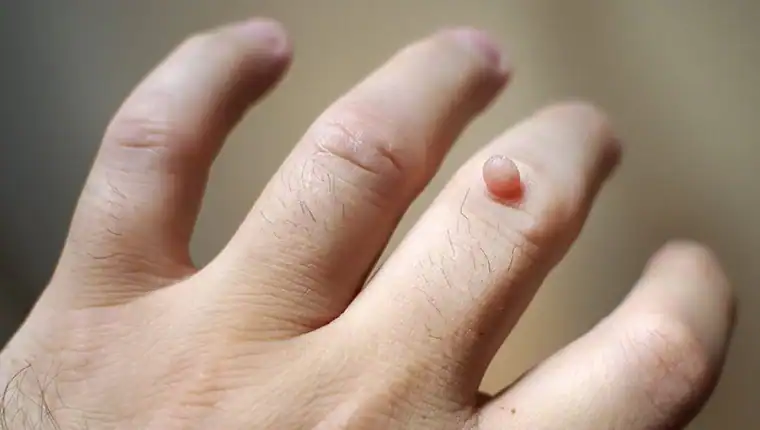 Cryotherapy For Warts And Also Verrucas 1 Image of blemish that Cryotherapy Maidstone can remove with Lipo 360.