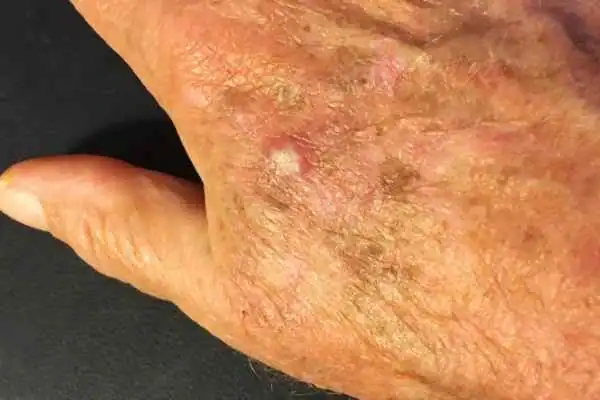 Cryopen For Actinic Keratoses 1 Image of Actinic keratoses Maidstone on a person hand